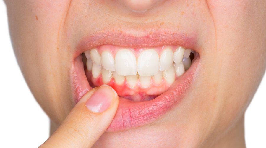 ¿Qué son los abscesos dentales?